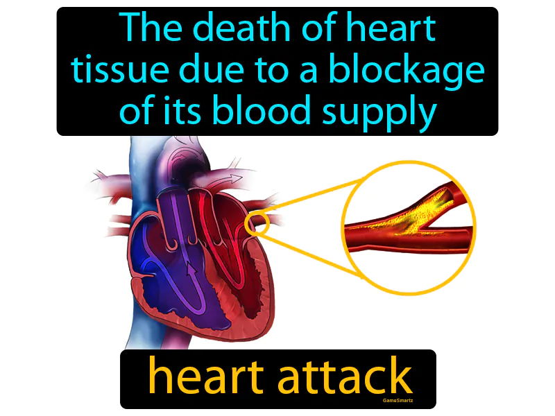 Heart attack Definition